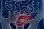 sus-adota-novo-exame-para-rastrear-cancer-colorretal-na-populacao