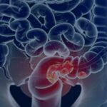 sus-adota-novo-exame-para-rastrear-cancer-colorretal-na-populacao