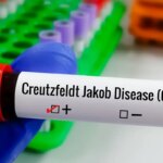 entenda-doenca-de-creutzfeldt-jakob-e-busca-por-tratamento
