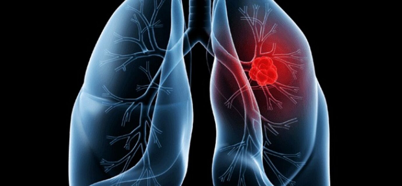 saiba-o-que-e-adenocarcinoma-pulmonar,-cancer-que-atinge-o-papa-leao