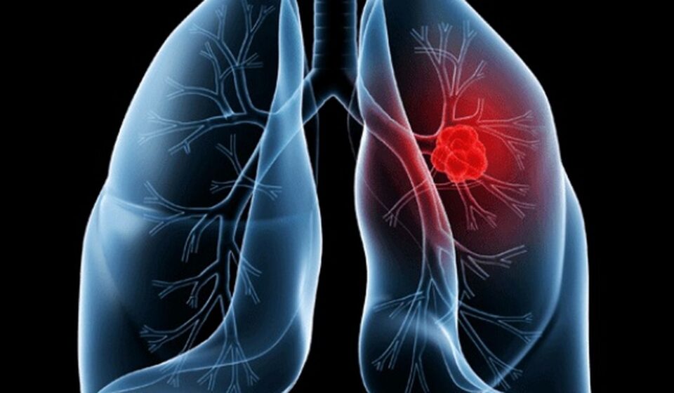 saiba-o-que-e-adenocarcinoma-pulmonar,-cancer-que-atinge-o-papa