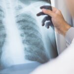 anvisa-aprova-novo-medicamento-para-cancer-de-pulmao-avancado