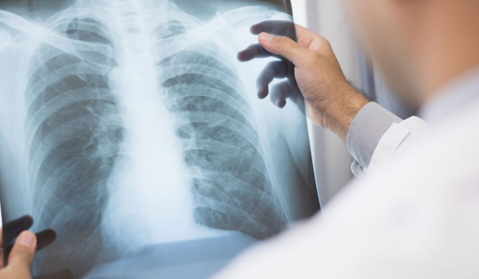 anvisa-aprova-novo-medicamento-para-cancer-de-pulmao-avancado